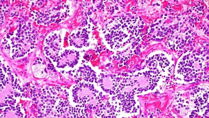 neuroblastoma