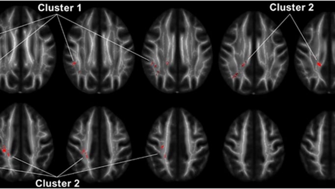 White matter regions