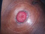A picture of an end colostomy