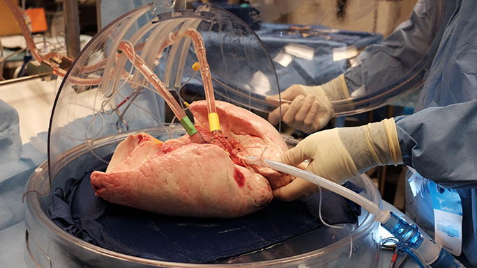 ex vivo lung perfusion