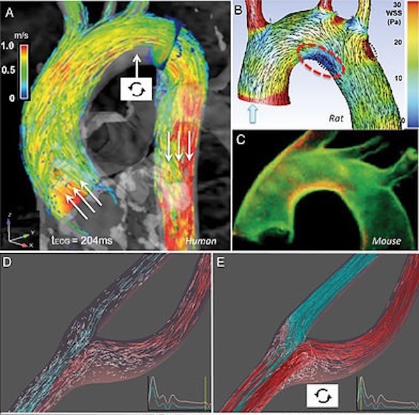 Blood vessel turbulence