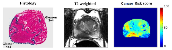 MRI risk maps