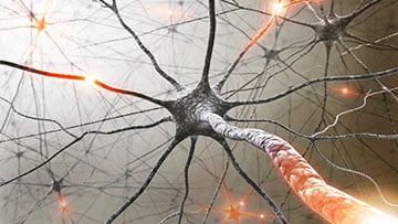Multiple sclerosis cells