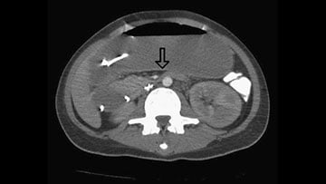 Brain scan of SMA snydrome