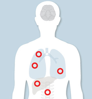 metastatic cancer illustration