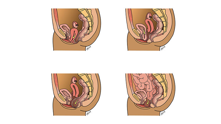 https://www.uchicagomedicine.org/-/media/images/ucmc/module-images/image-slider/obgyn/prolapse-types-760x427.jpg