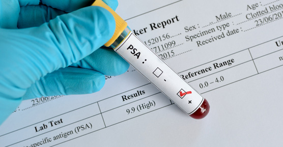 PSA screening blood vile