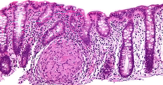 Pediatric IBD: Symptoms, Diagnosis and Treatment - UChicago Medicine