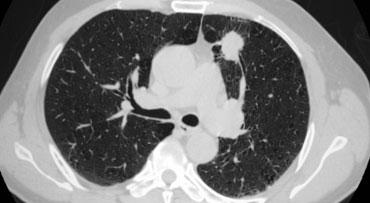 Lung CT scan