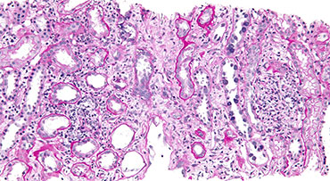 High magnification micrograph of post-kidney transplantation polyomavirus nephropathy.