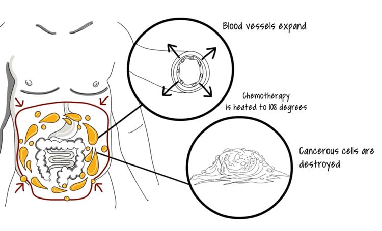 how does papillary thyroid cancer kill you