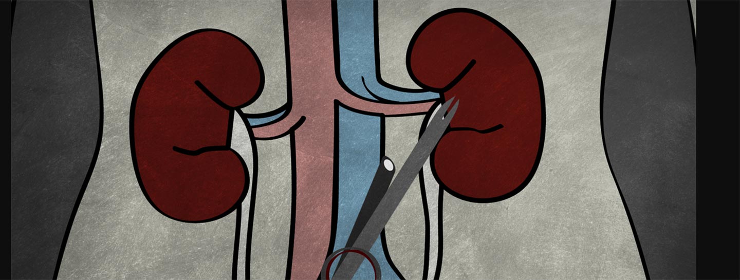single port nephrectomy