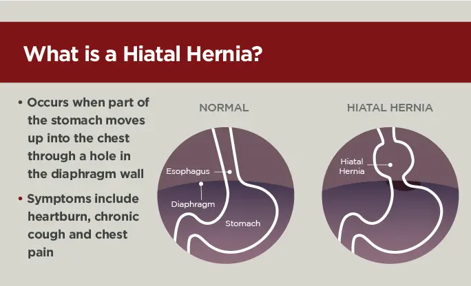 what is a hiatal hernia