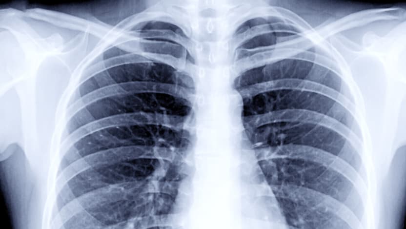 X-ray of chest