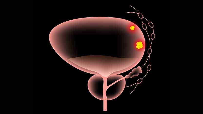Illustration of bladder cancer stages