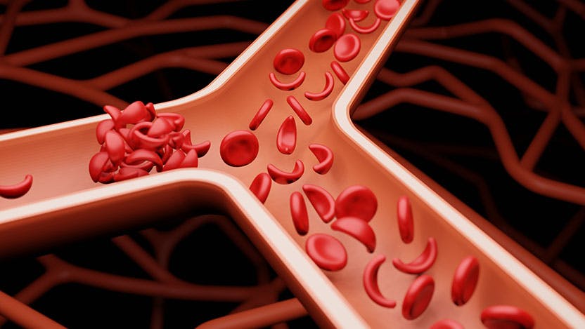 Illustration depicting sickling of red blood cells, which are typically disc-shaped but become crescent- or sickle-shaped as a result of sickle cell disease.
