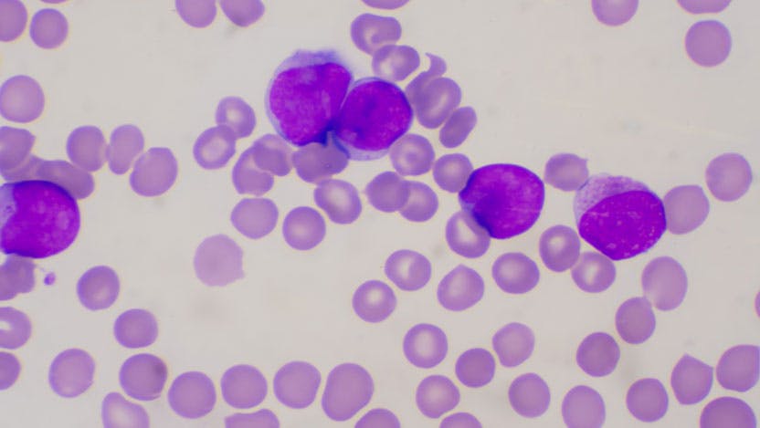 immature white blood cells in blood smear leukemia concept