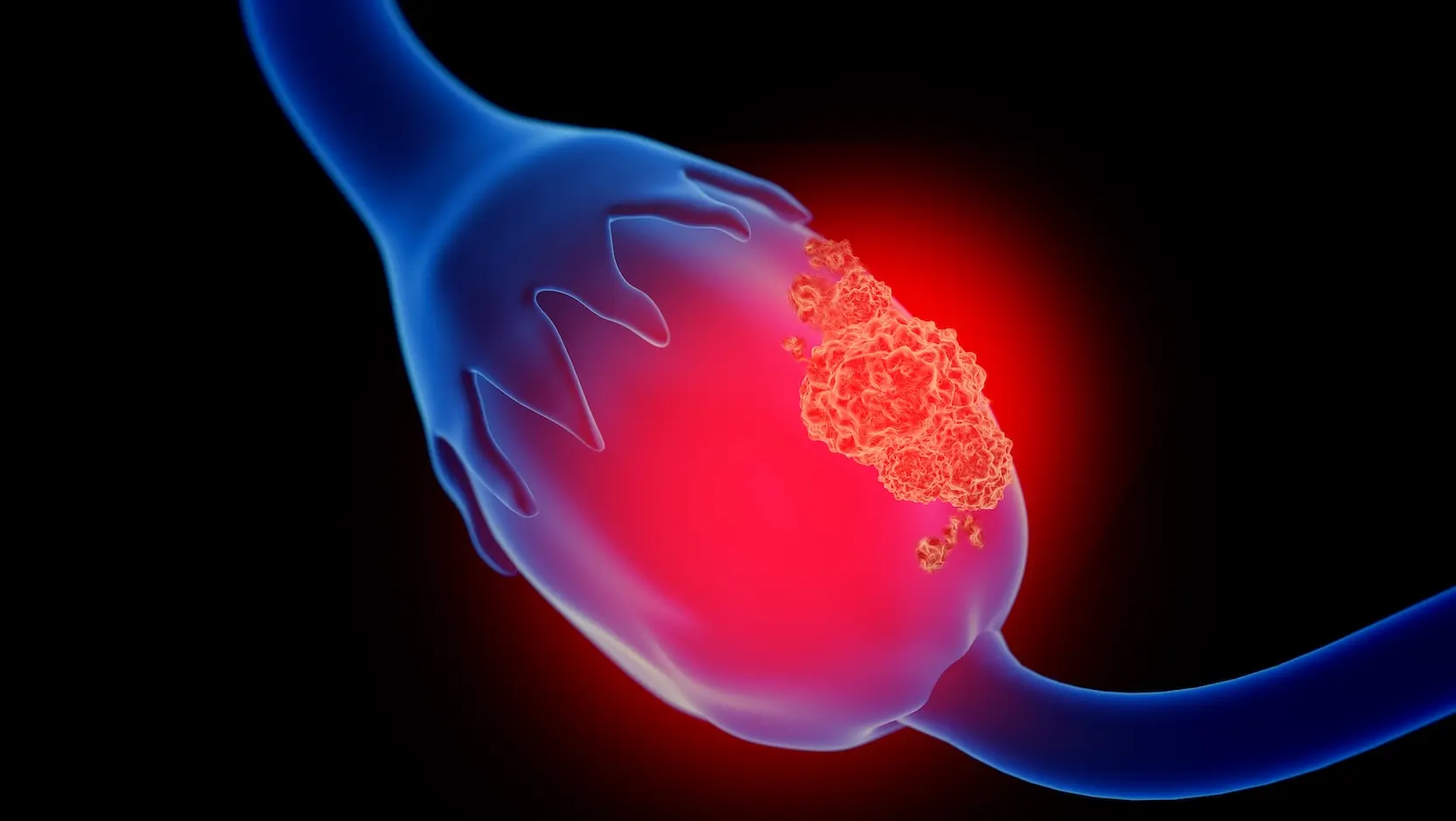 3d illustration of ovarian cancer