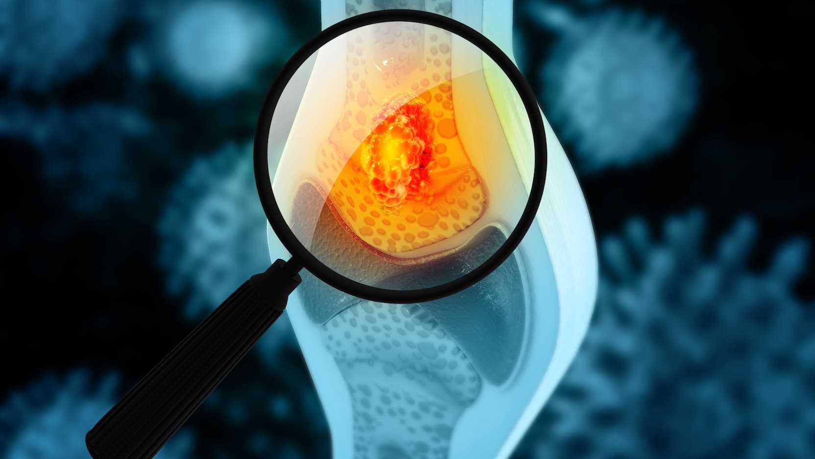 sarcoma in bone with a magnifying glass