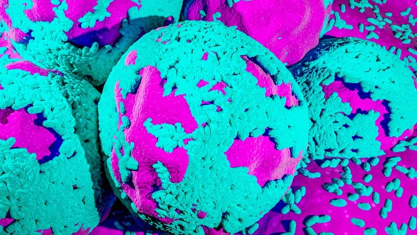 ovarian cancer cells stock