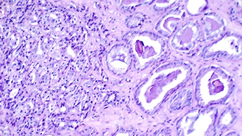 Histological slide showing prostate cancer