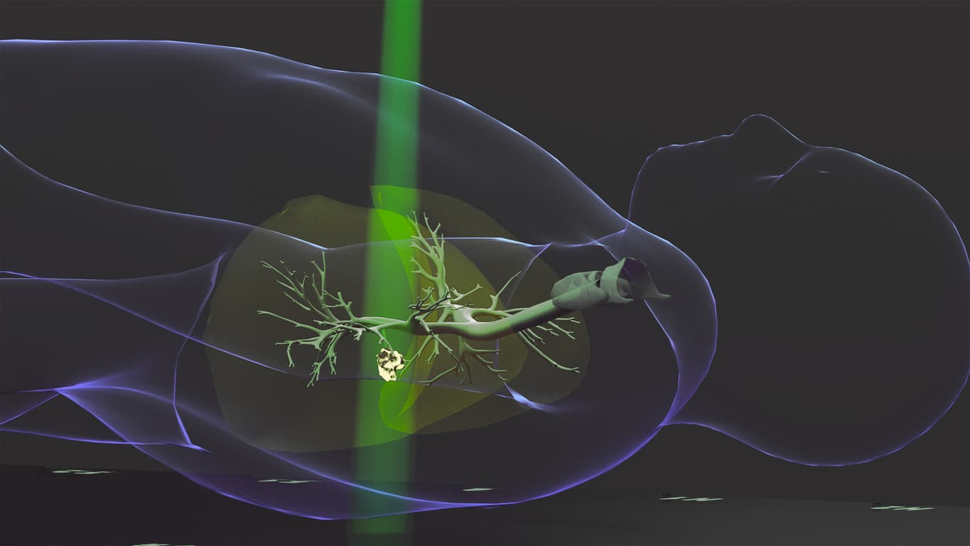 Lung tumor receiving stereotactic body radiation