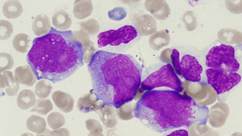 therapy-related myeloid neoplasm