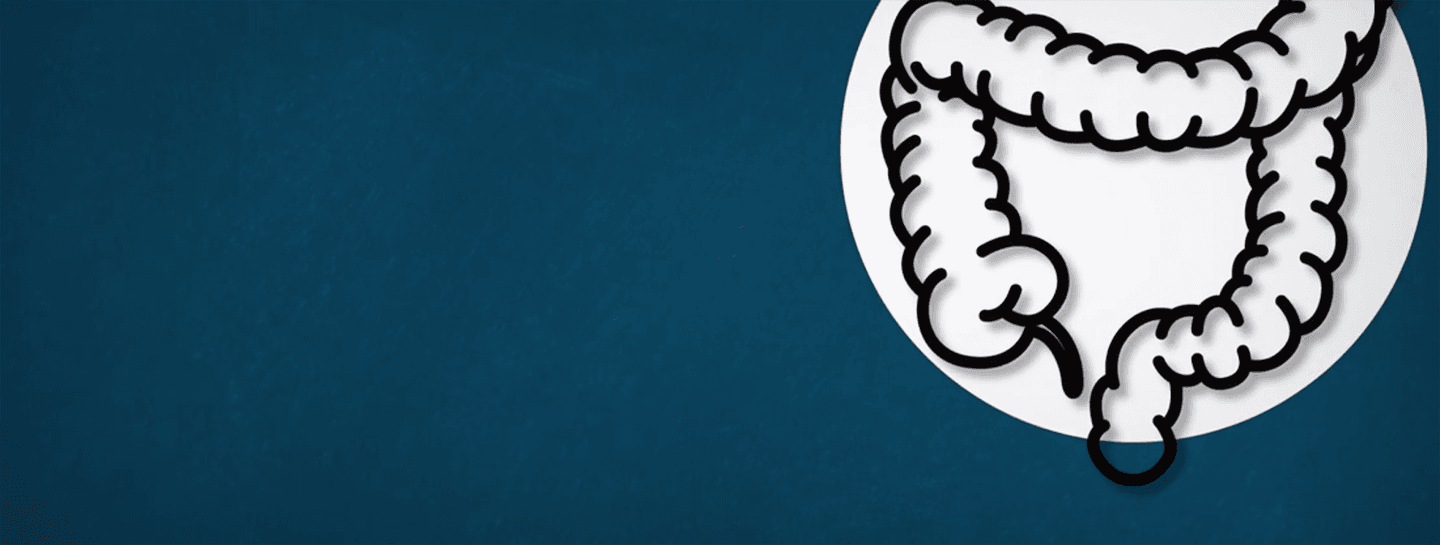 Colon cancer infographic
