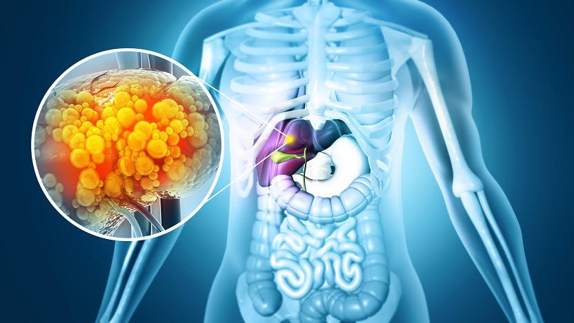 an x-ray style illustration of a human body with the liver highlighted in purple, with a zoomed-in bubble showing yellow and red bumps on the liver surface