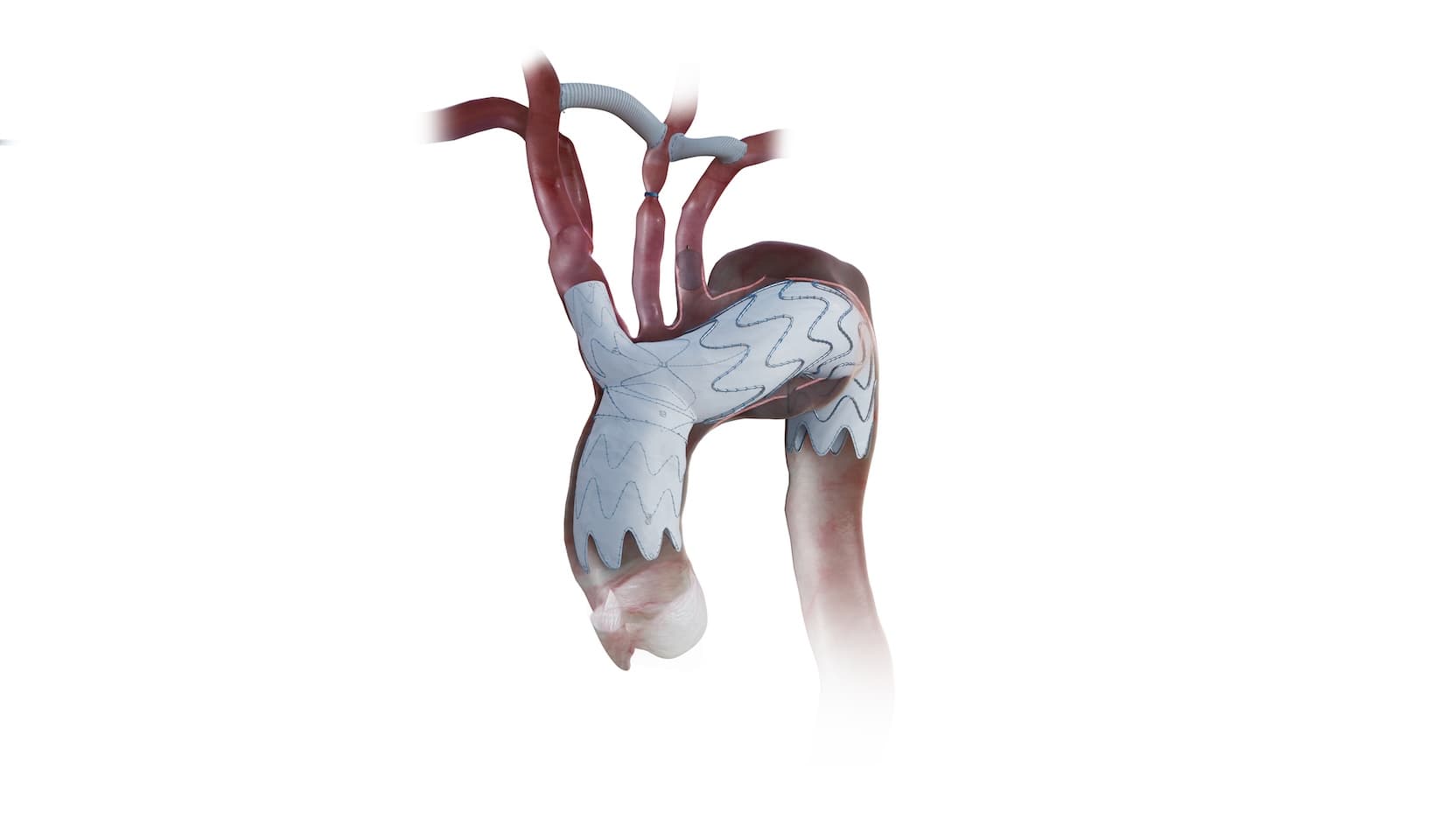 rendering of Nexus stent device