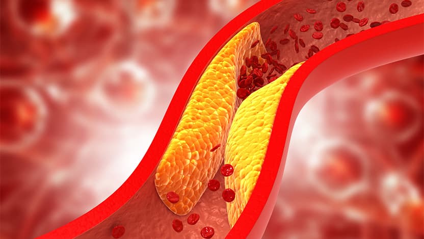 Peripheral Artery Disease