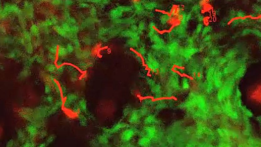 cytotoxic T cells (red) monitoring melanoma tumor cells (green) in vivo