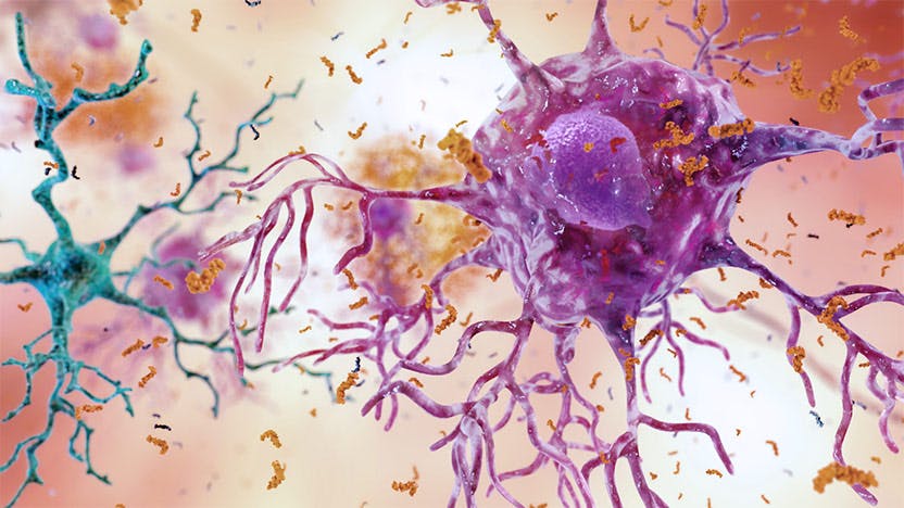 Brain cells with Alzheimer's disease