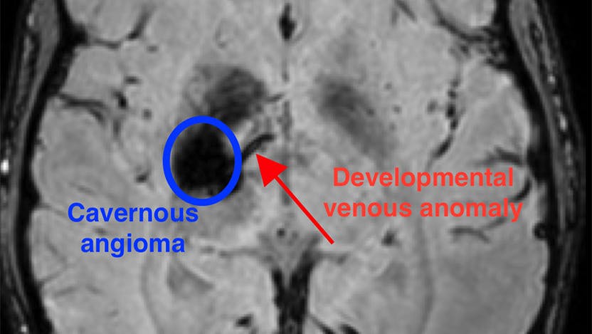 An MRI image showing both the venous anomaly that "seeds" the cavernous angioma, and the cavernous angioma itself.
