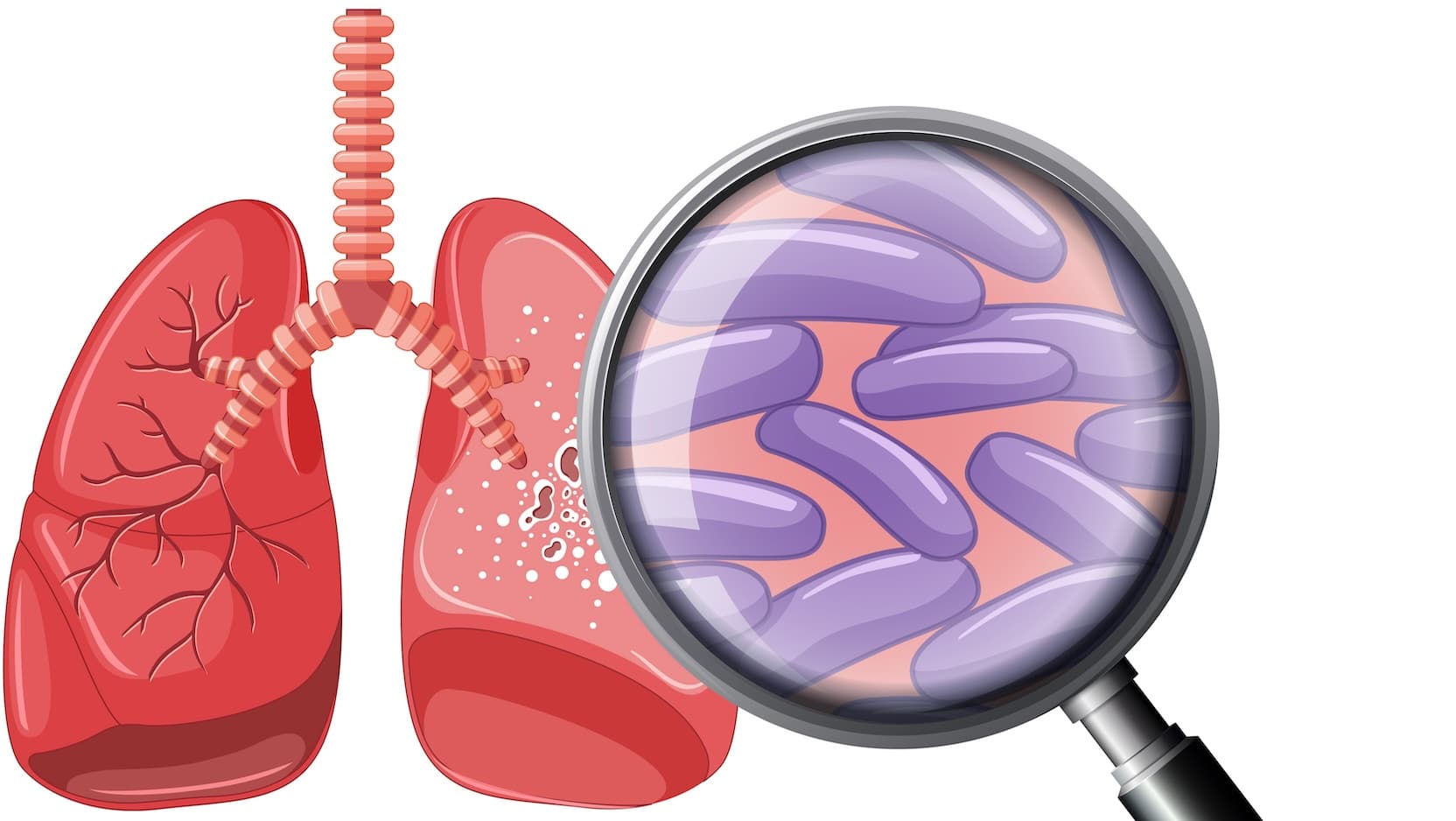 Human Lung with Tuberculosis stock illustration