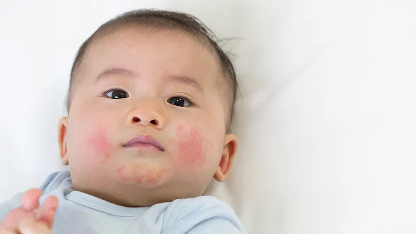 Baby with skin rash 