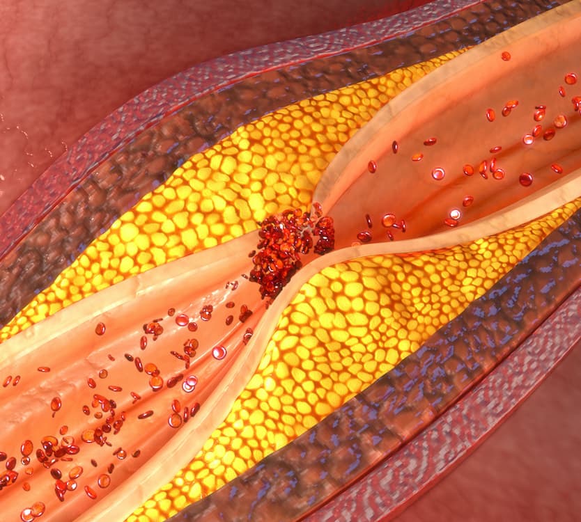 coronary artery plaque