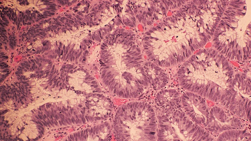 Colonic adenocarcinoma with H&E Staining