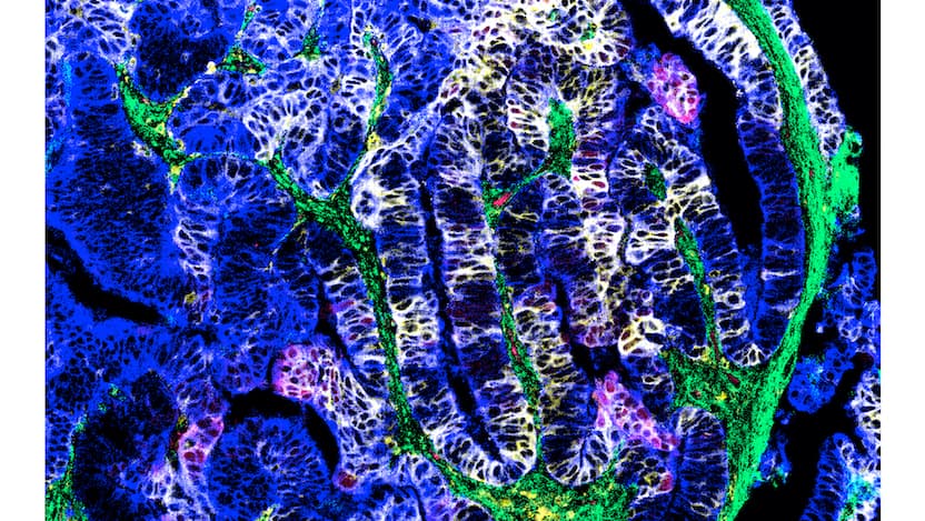 With treatment, tumor cells had more of both HLA-DR and IDO-1 proteins (together shown in yellow), suggesting increased local inflammation and anti-tumor activity. Credit: Sebastiano Battaglia