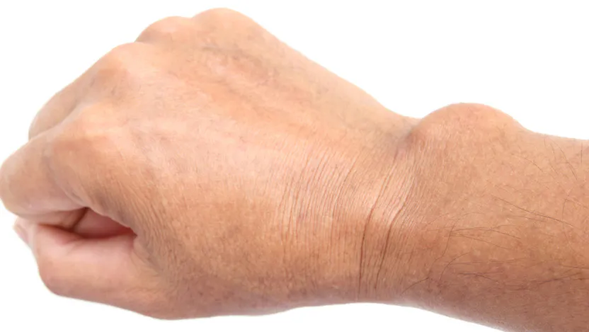 A ganglion cyst on a wrist