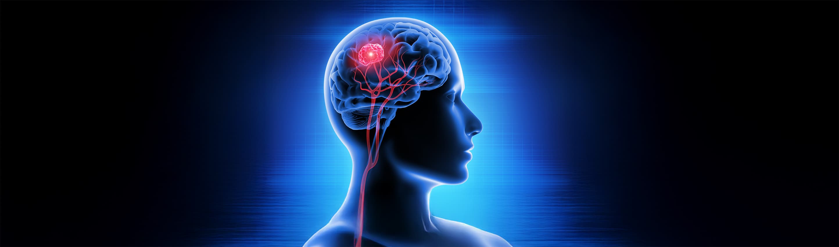 Brain Tumor hero