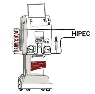 HIPEC machine