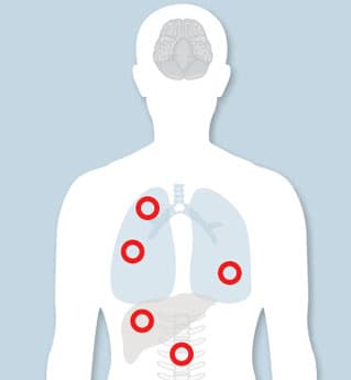 metastatic cancer illustration