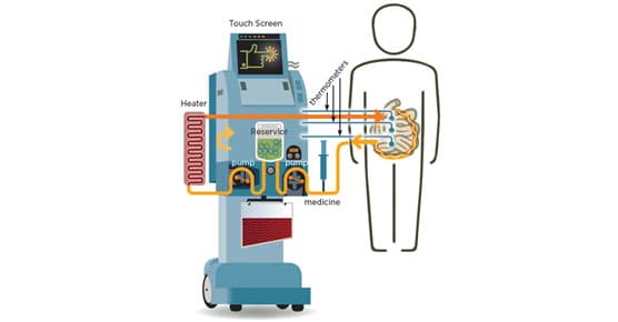 Hyperthermic intraperitoneal chemoperfusion (HIPEC)