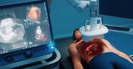 Histotripsy illustration