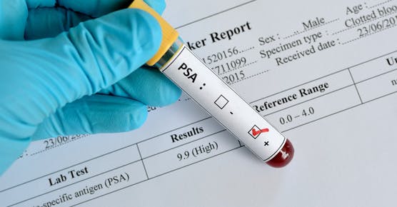 PSA screening blood vile